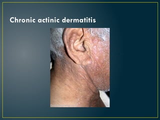 Chronic actinic dermatitis
 