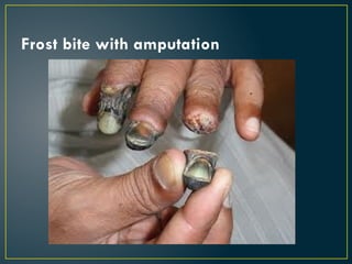 Frost bite with amputation
 