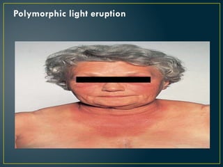 Polymorphic light eruption
 