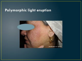 Polymorphic light eruption
 