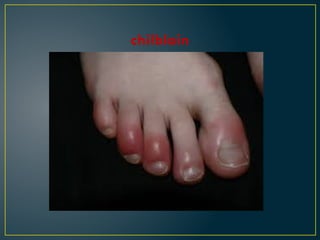 chilblain
 