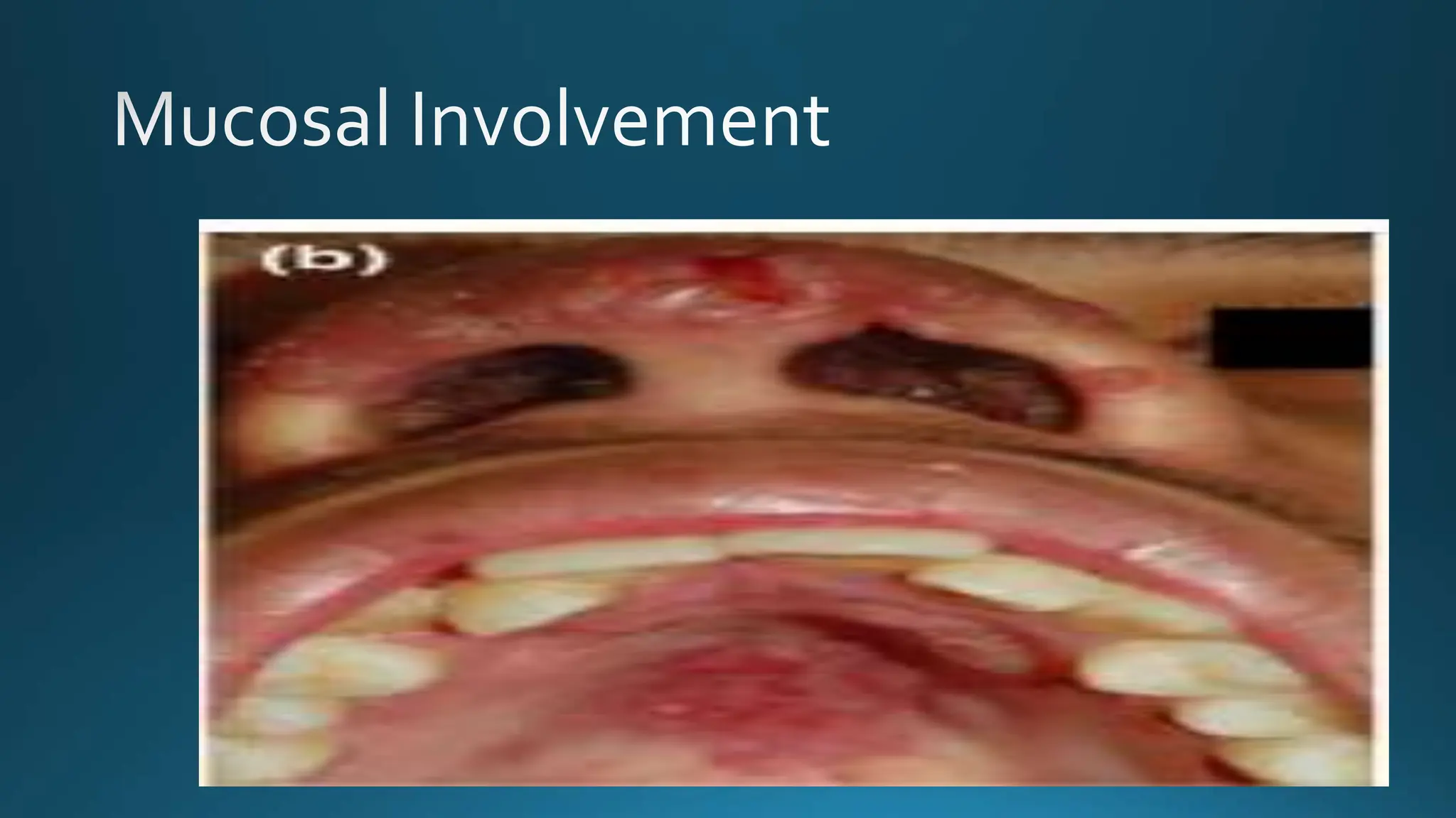 Mamagement and diagnosis of cutaneous tb pptx