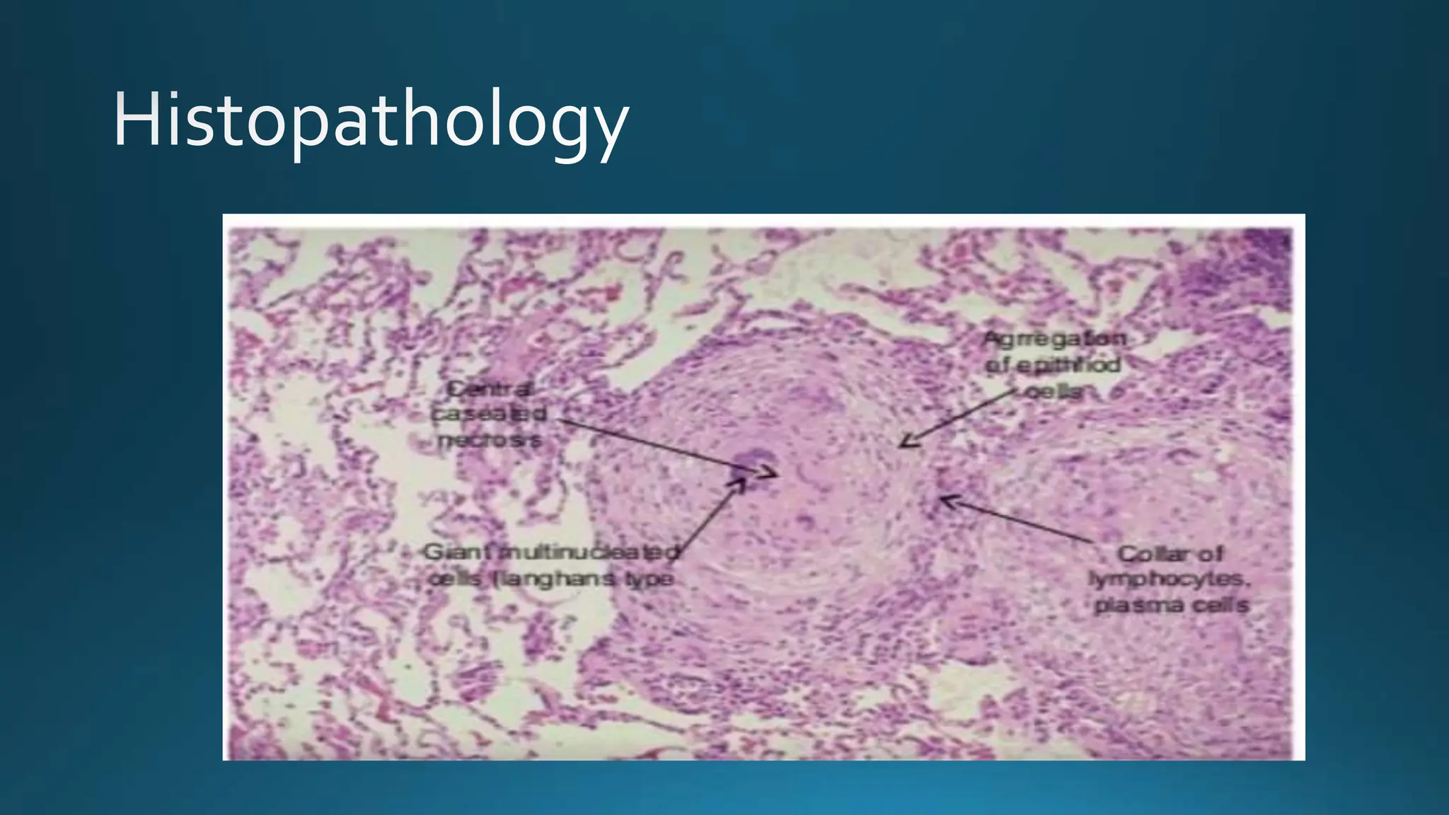 Mamagement and diagnosis of cutaneous tb pptx