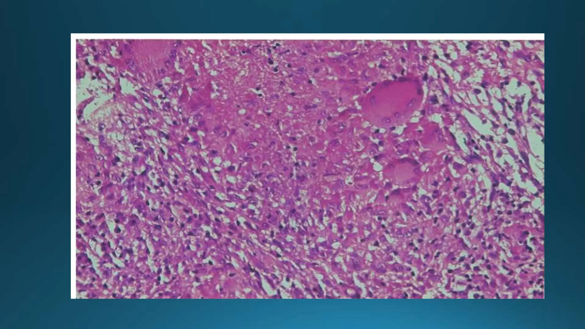 Mamagement and diagnosis of cutaneous tb pptx