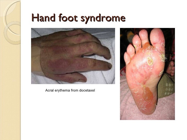 Cutaneous Toxicities Of Cancer Therapy