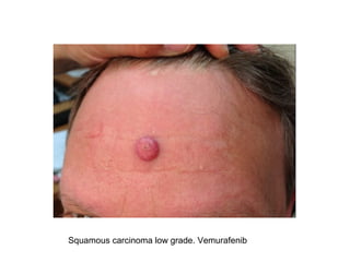 Squamous carcinoma low grade. Vemurafenib

 