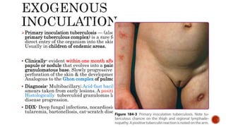 Primary inoculation tuberculosis — (also known as tuberculous chancre &
primary tuberculous complex) is a rare form of cutaneous TB that results from the
direct entry of the organism into the skin or mucosa of a nonsensitized individual.
Usually in children of endemic areas.
 Clinically- evident within one month after inoculation; nondescript red-brown
papule or nodule that evolves into a painless, shallow & undermined ulcer with a
granulomatous base. Slowly progressive & painless regional lymphadenopathy;
perforation of the skin & the development of draining sinuses occasionally.
Analogous to the Ghon complex of pulmonary TB infection.
 Diagnosis- Multibacillary; Acid-fast bacilli (AFB) are usually easily detected in
smears taken from early lesions. A positive culture confirms the diagnosis.
Histologically tuberculoid granulomas late in course; TST –ve at onset, +ve with
disease progression.
 DDX- Deep fungal infections, nocardiosis, syphilis, leishmaniasis, yaws,
tularemia, bartonellosis, cat-scratch disease, & other mycobacterioses.
 