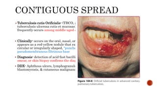Tuberculosis cutis Orificialis- (TBCO, also known as orificial tuberculosis &
tuberculosis ulcerosa cutis et mucosae) is a rare manifestation of TB that most
frequently occurs among middle-aged & older adults.
 Clinically- occurs on the oral, nasal, or Anogenital skin or mucosa; A typical lesion
appears as a red-yellow nodule that rapidly breaks down to form a painful,
circular or irregularly shaped, "punched-out" & friable 1 to 3 cm ulcer with a
pseudomembranous fibrinous base
 Diagnosis- detection of acid-fast bacilli in affected tissue via culture, stained
smear, or skin biopsy confirms the diagnosis; TST -ve
 DDX- Aphthous ulcers, lymphogranuloma venereum, syphilis, South American
blastomycosis, & cutaneous malignancies
 
