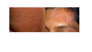 Tb Rashes Cutaneous tuberculosis | PPTX