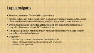 Lupus vulgaris
• The most common form of skin tuberculosis
• Painful cutaneous tuberculosis skin lesions with nodular appearance, most
often on the face around the nose, eyelids, lips, cheeks, ears and neck
• Often develops due to inadequately treated pre-existing tuberculosis, it
may also develop at site of BCG vaccination
• It begins as painless reddish-brown nodules which slowly enlarge to form
irregularly shaped red plaque
• Diagnosis-
• On diascopy, it shows characteristic "apple-jelly" color
• Biopsy will reveal tuberculoid granuloma with few bacilli
• Mantoux test is positive
 