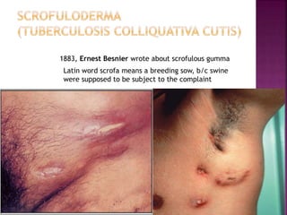 Scrofuloderma Presentation Scrofuloderma