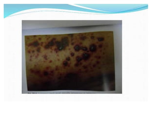 Cutaneous vasculitis