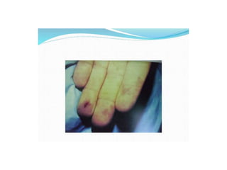 Cutaneous vasculitis