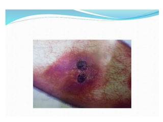 Cutaneous vasculitis