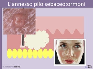 dr.ssa Federica Osti MD
L’annesso pilo sebaceo:ormoni
dermaGhiandola
sebacea
Pelo e bulbo
pilifero
 