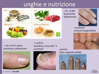 76
dr.ssa Federica Osti MD
unghie e nutrizione
< vit A Vit D calcio:
secchezza, esfoliazione
< vit B12:
secchezza, incurvate “a
cucchiaio” anemia:
letto ungueale pallido
< Zn, vit B6:
leuconichia
sfaldamento
< proteine:
striature longitudinali
 