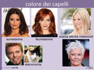 84
dr.ssa Federica Osti MD
colore dei capelli
eumelanine feumelanine
eterocromia
scarsa attività melanociti
 