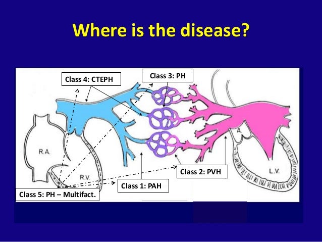 Pulmonary Arterial Hypertension: The Other High Blood Pressure