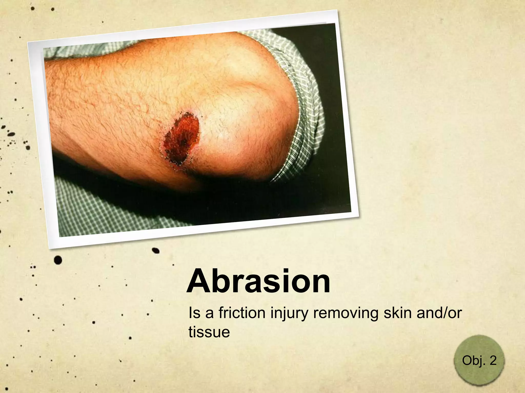 Abrasion
Is a friction injury removing skin and/or
tissue
Obj. 2
 