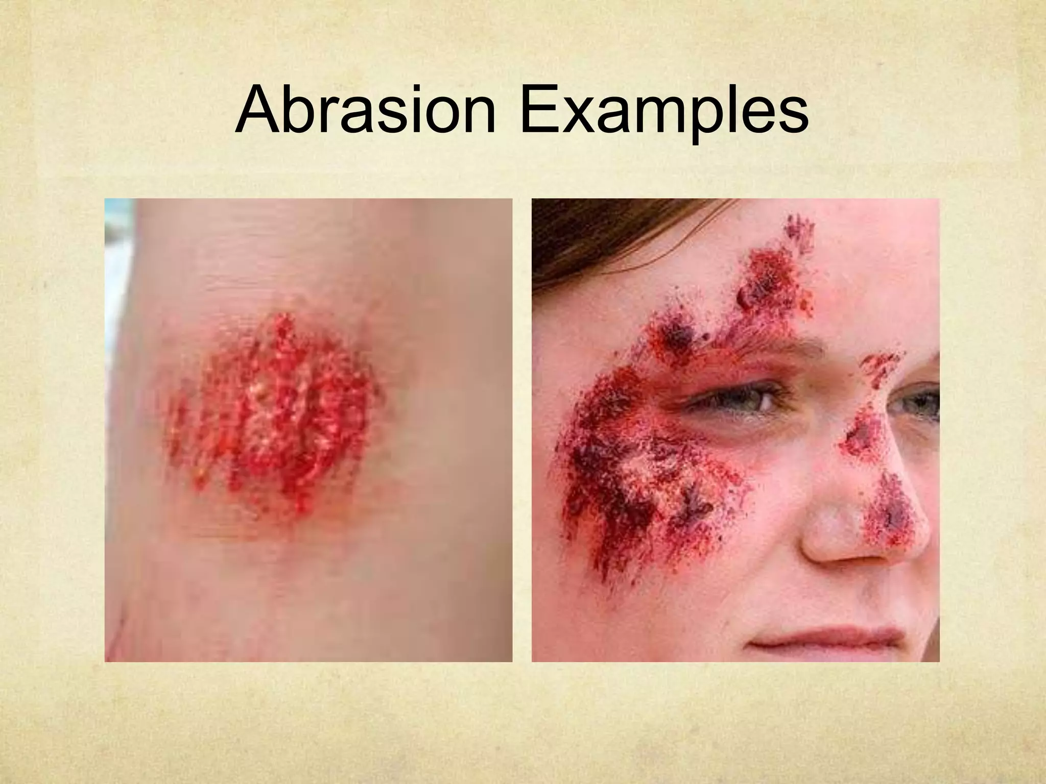 Abrasion Examples
 