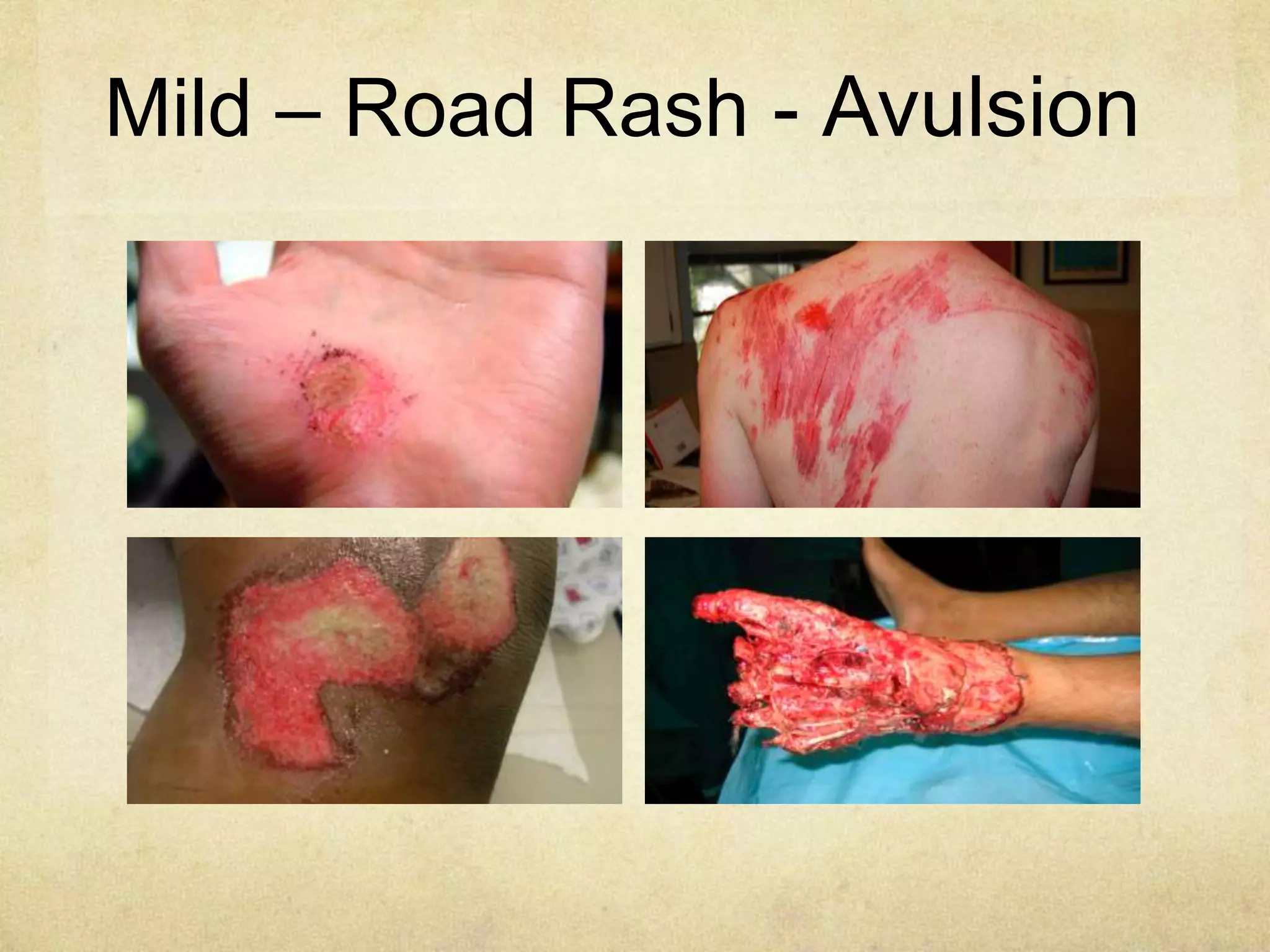 Mild – Road Rash - Avulsion
 