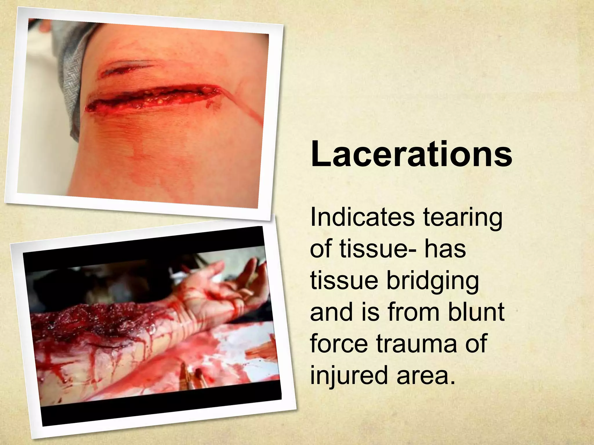 Lacerations
Indicates tearing
of tissue- has
tissue bridging
and is from blunt
force trauma of
injured area.
 