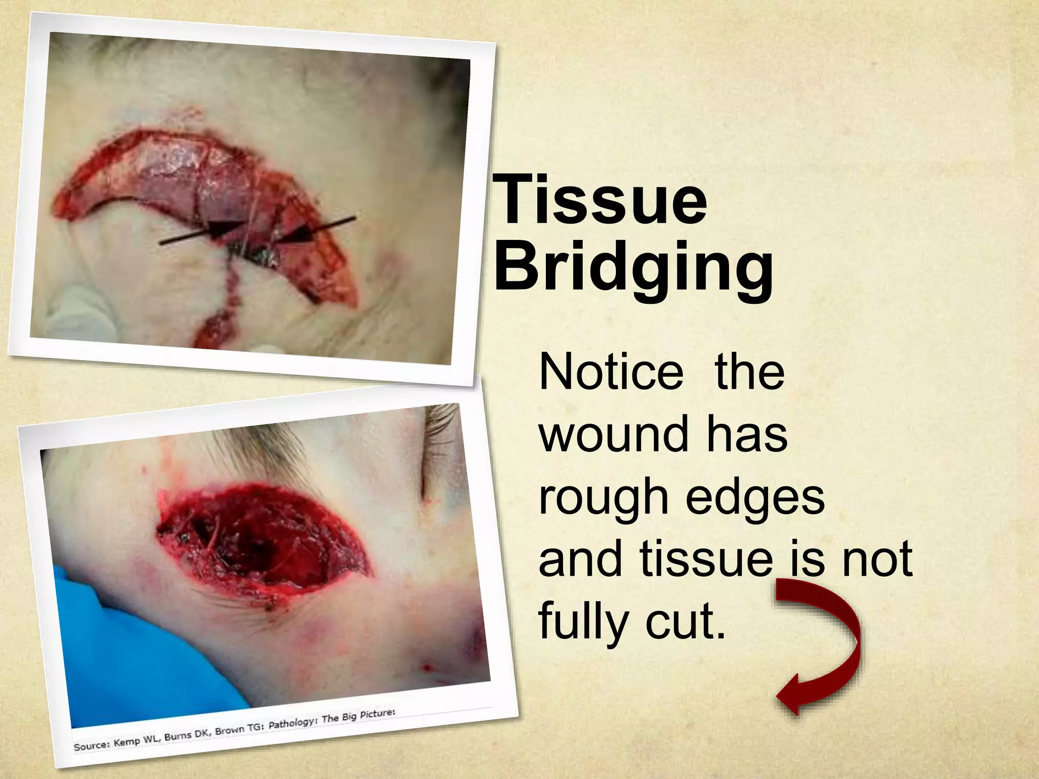 Tissue
Bridging
Notice the
wound has
rough edges
and tissue is not
fully cut.
 