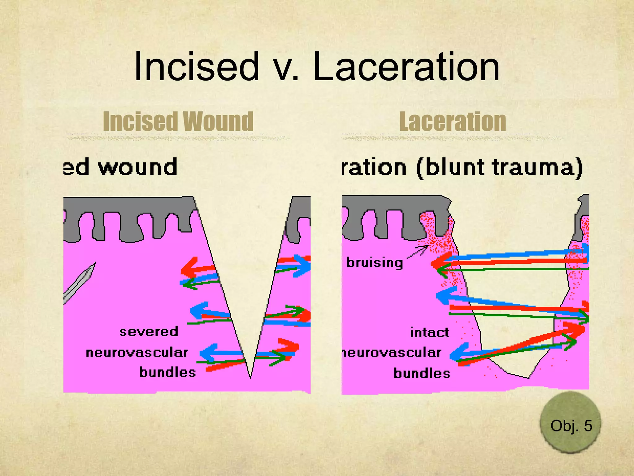 Incised v. Laceration
Incised Wound Laceration
Obj. 5
 
