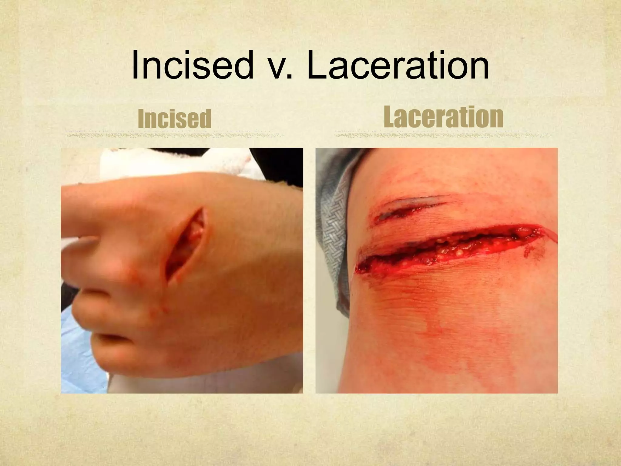 Incised v. Laceration
Incised Laceration
 