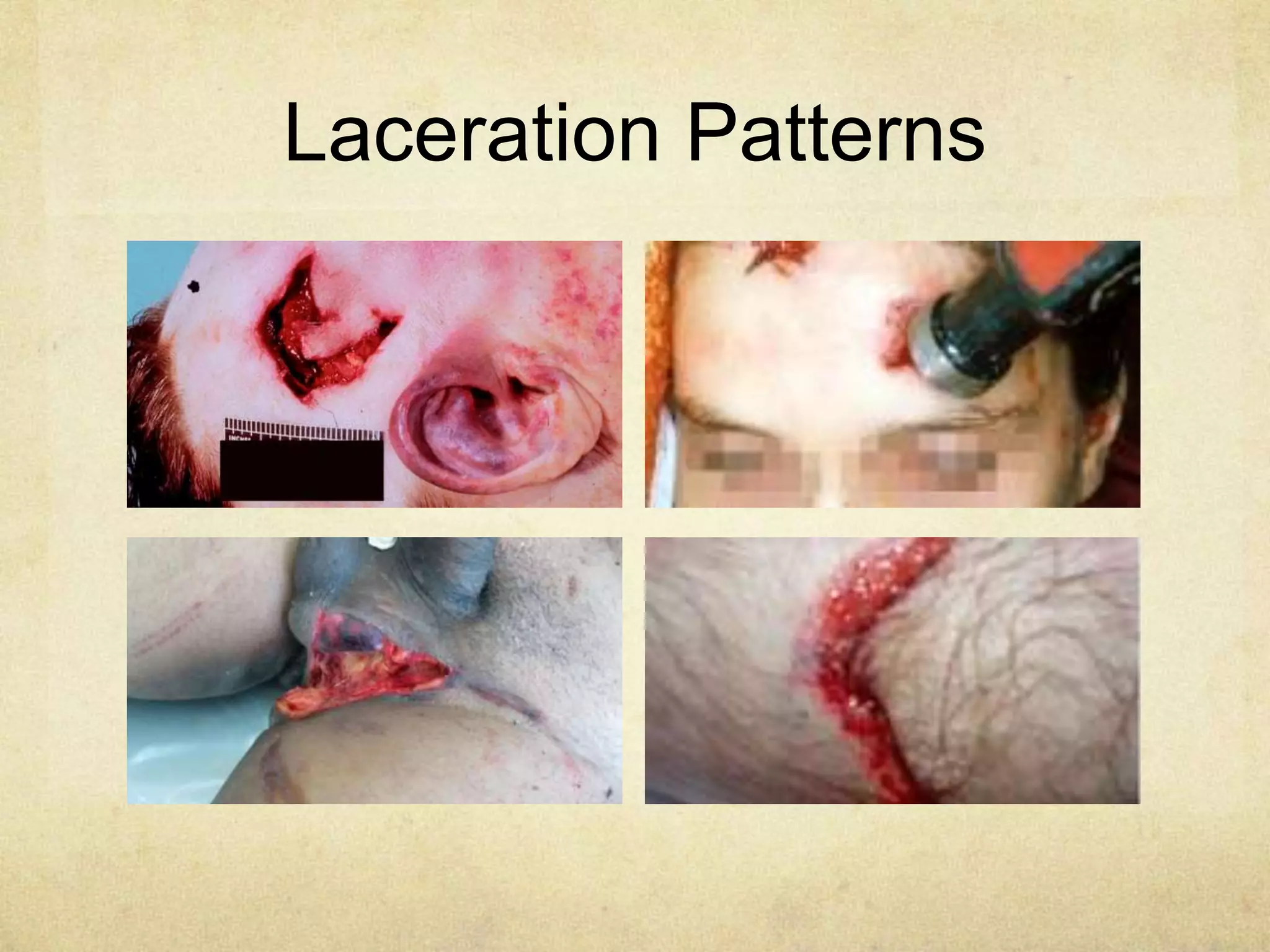 Laceration Patterns
 