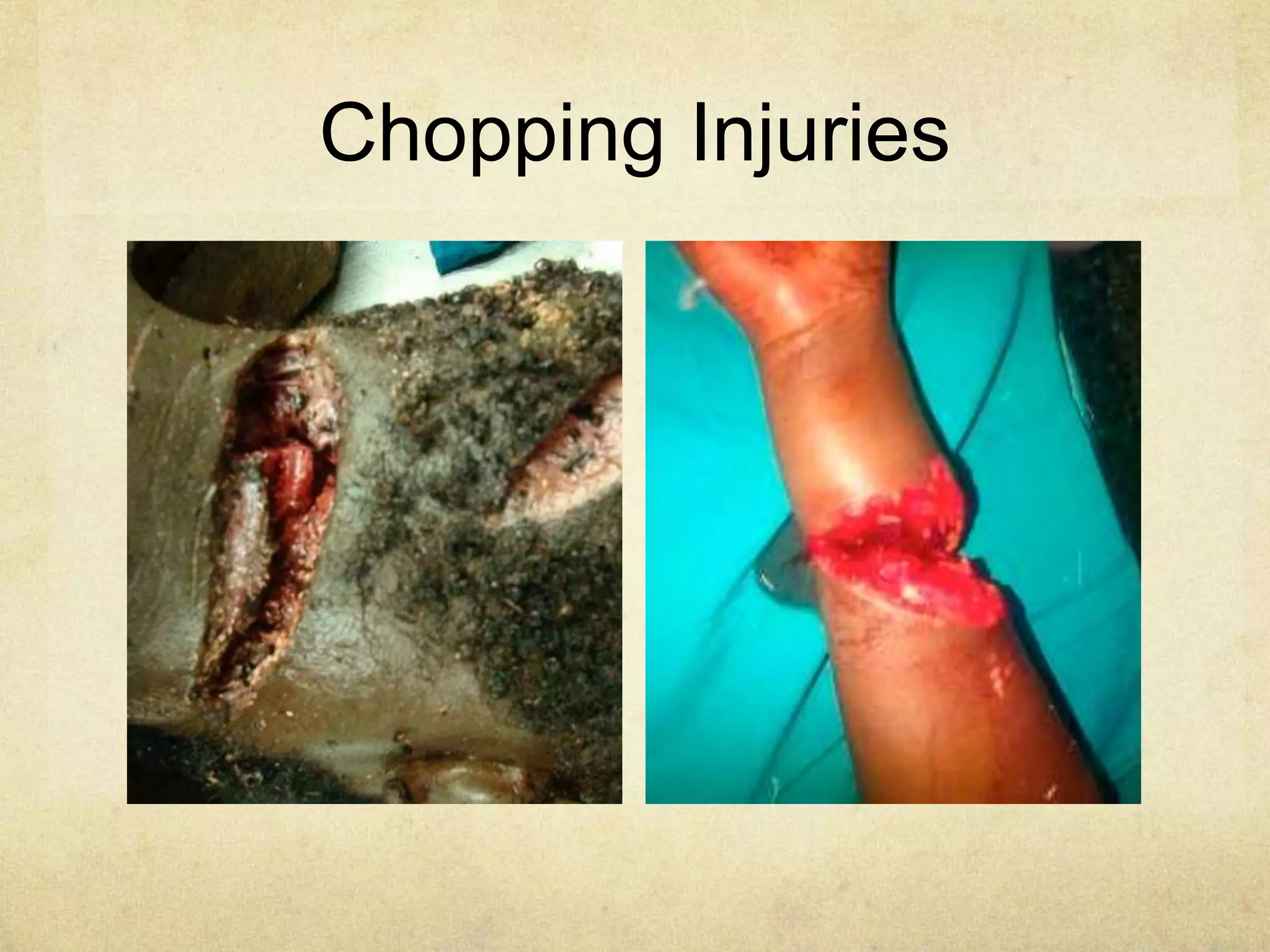 Chopping Injuries
 