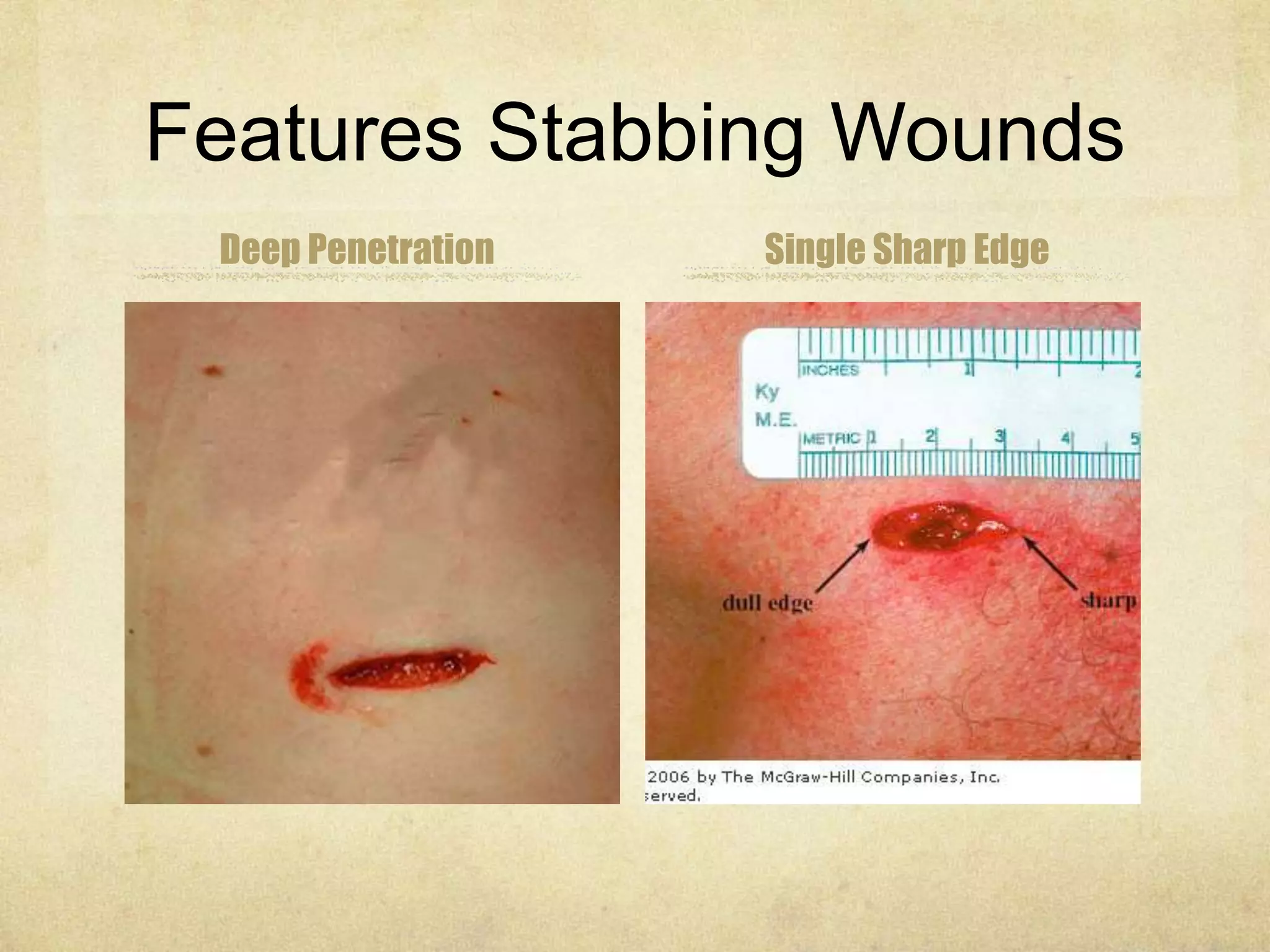 Features Stabbing Wounds
Deep Penetration Single Sharp Edge
 