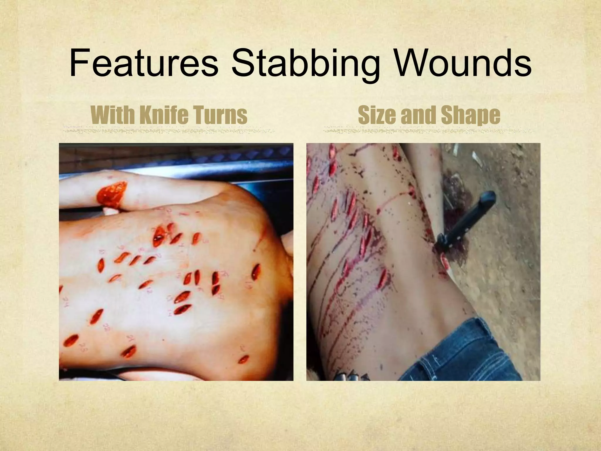 Features Stabbing Wounds
With Knife Turns Size and Shape
 
