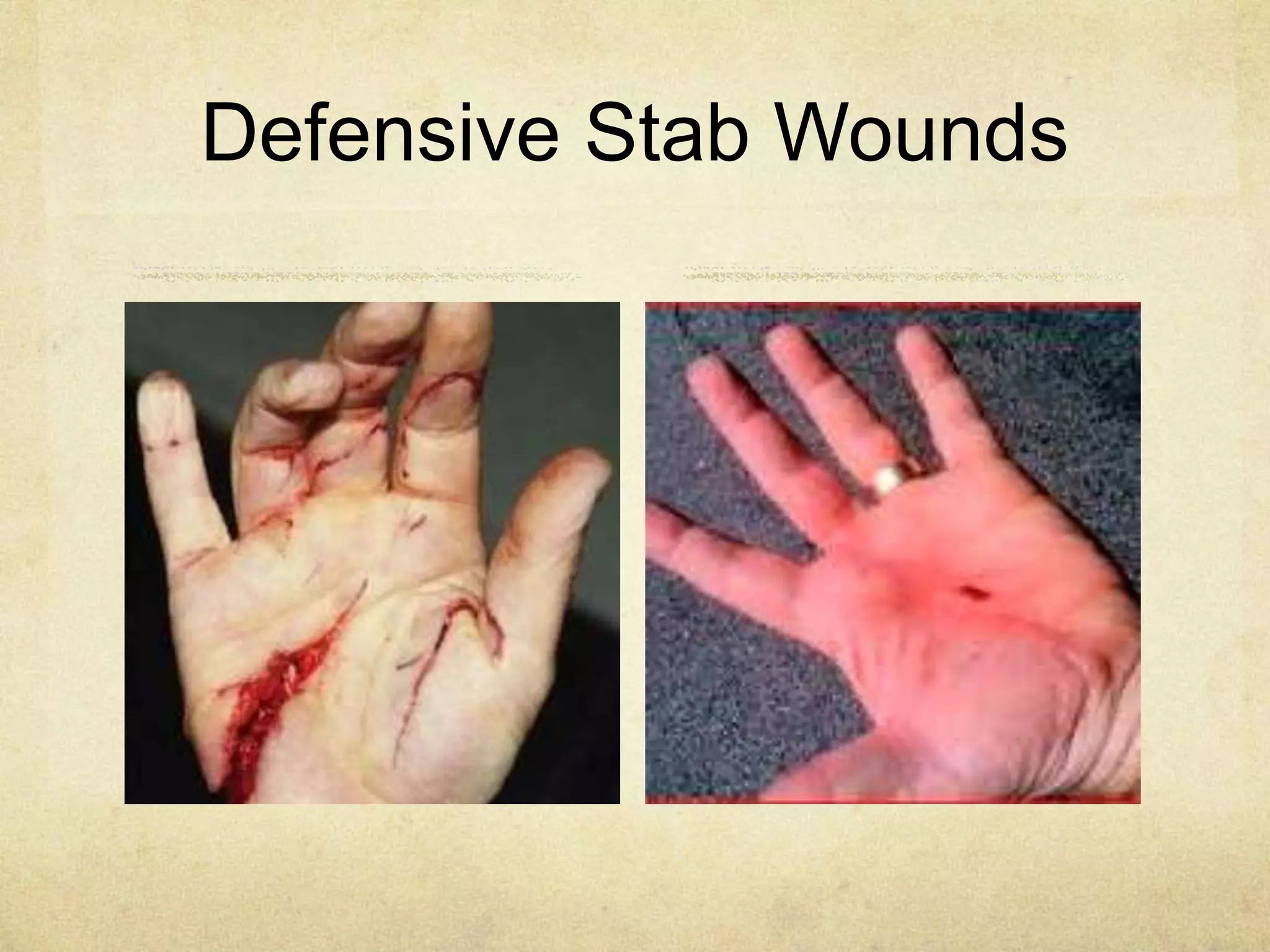 Defensive Stab Wounds
 