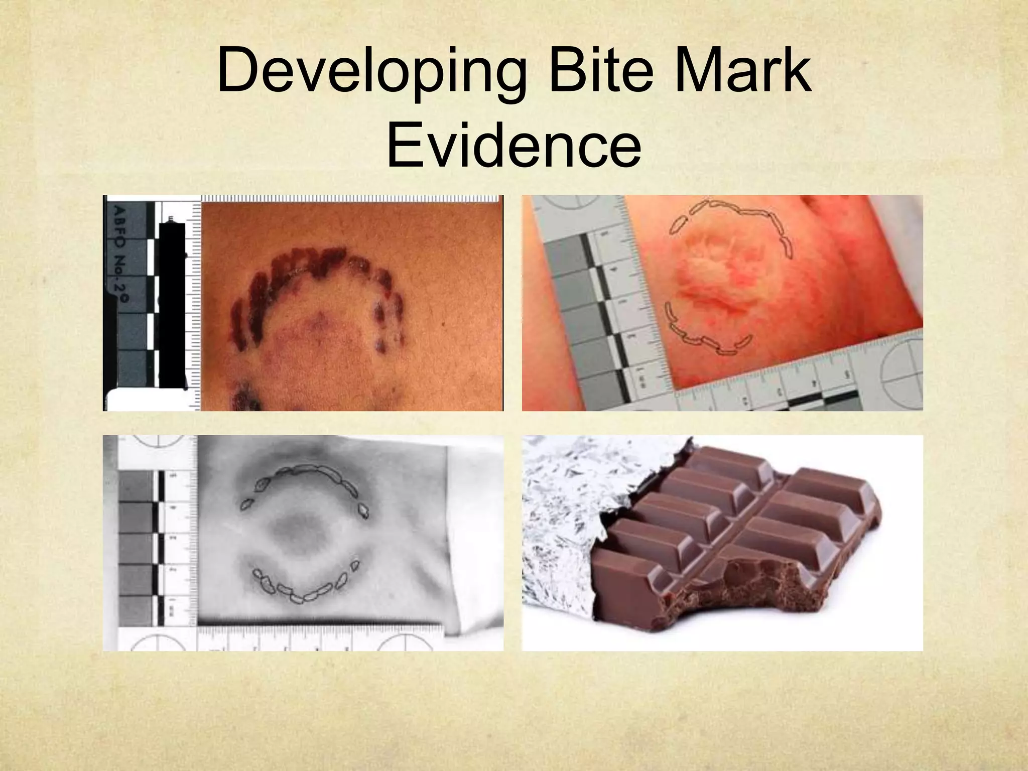 Developing Bite Mark
Evidence
 