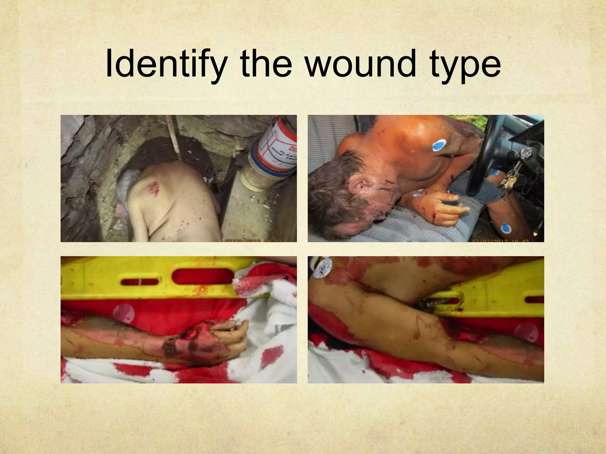 Identify the wound type
 