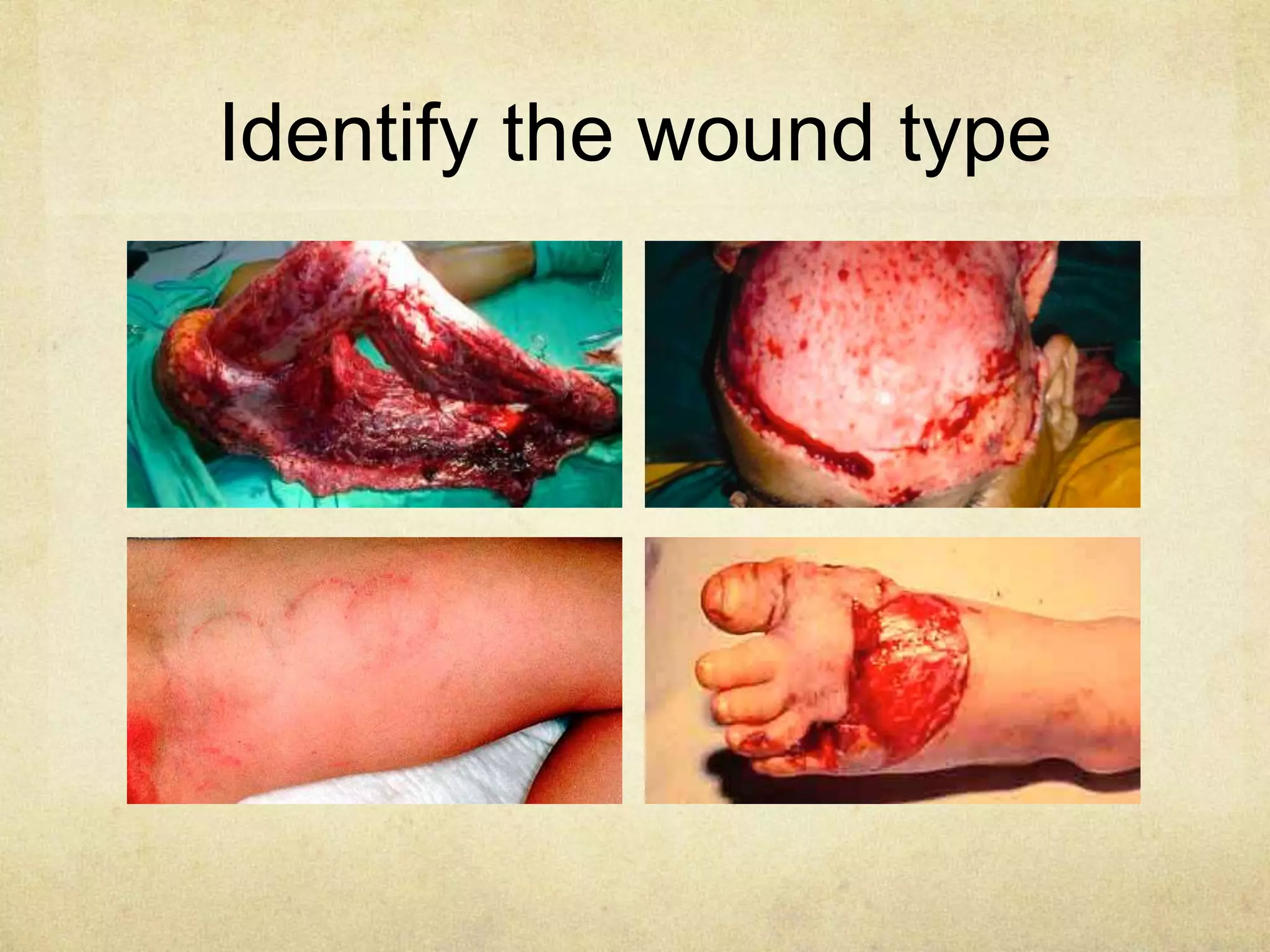 Identify the wound type
 
