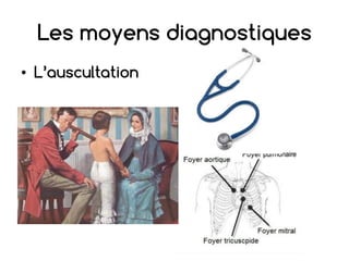 Les moyens diagnostiques
• L’auscultation
 