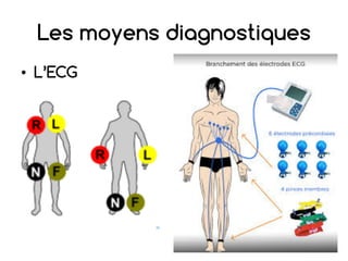 Les moyens diagnostiques
• L’ECG
 