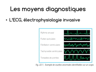 Les moyens diagnostiques
• L’ECG, électrophysiologie invasive
 