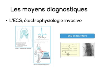 Les moyens diagnostiques
• L’ECG, électrophysiologie invasive
 