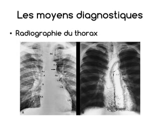 Les moyens diagnostiques
• Radiographie du thorax
 