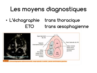 Les moyens diagnostiques
• L’échographie trans thoracique
ETO trans œsophagienne
 
