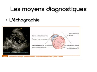 Les moyens diagnostiques
• L’échographie
 