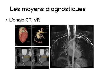 Les moyens diagnostiques
• L’angio CT, MR
 