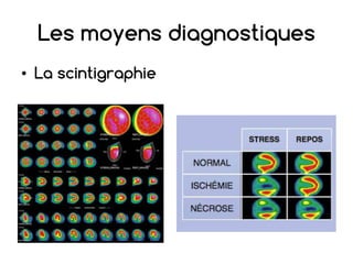 Les moyens diagnostiques
• La scintigraphie
 