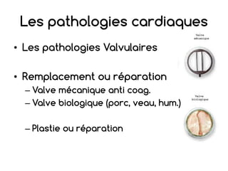 Les pathologies cardiaques
• Les pathologies Valvulaires
• Remplacement ou réparation
– Valve mécanique anti coag.
– Valve biologique (porc, veau, hum.)
– Plastie ou réparation
 