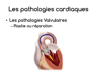 Les pathologies cardiaques
• Les pathologies Valvulaires
– Plastie ou réparation
 