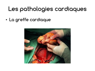 Les pathologies cardiaques
• La greffe cardiaque
 