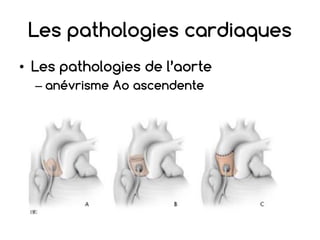 Les pathologies cardiaques
• Les pathologies de l’aorte
– anévrisme Ao ascendente
 